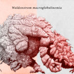Waldenstrom macroglobulinemia - a rare blood cell cancer embodied here in an illustration of a lumbering mutated creature.